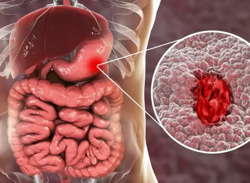 GI Cancer Surgery